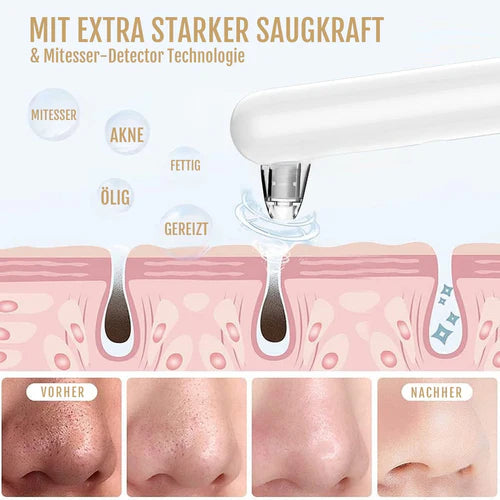 Mitesserentferner mit Kamera