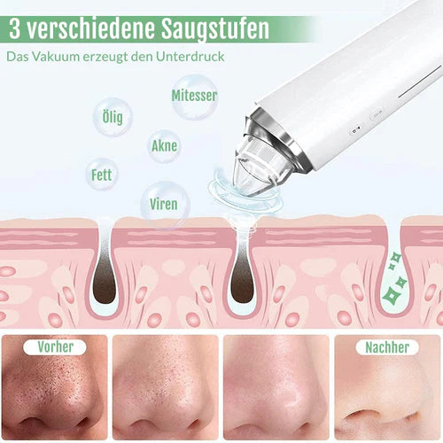 Mitesserentferner mit Kamera