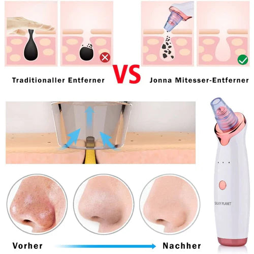 Mitesserentferner SkinClear 3