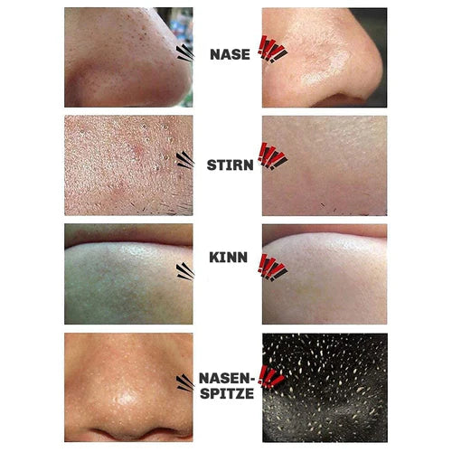 Mitesserentferner Maske