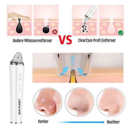 Mitesserentferner mit Kamera