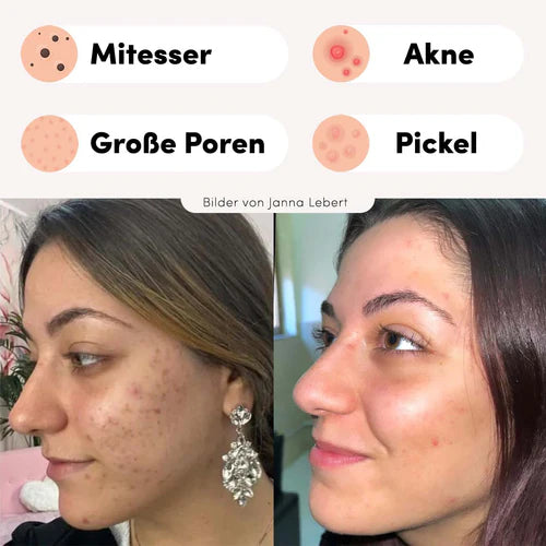 Mitesser Entferner Creme